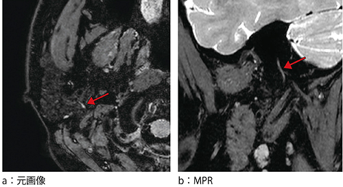 図1　耳下腺内顔面神経の描出方法：元画像とMPR