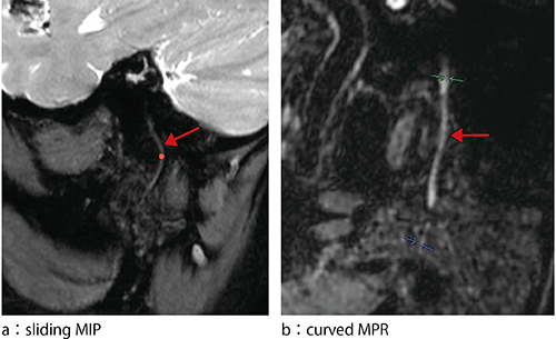 図2　耳下腺内顔面神経の描出方法：sliding MIPとcurved MPR
