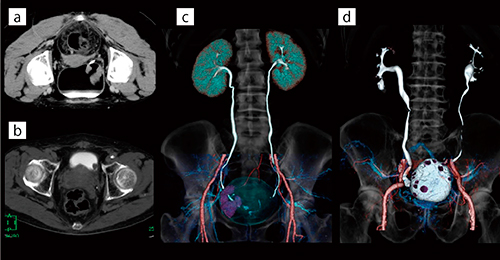 図1　膀胱腫瘍におけるオリーブオイル膀胱注入あり，注入なしのCT画像