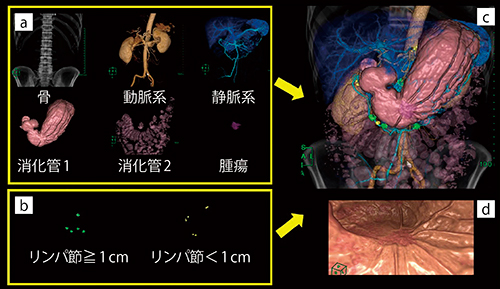 図4　消化管腫瘍におけるマルチボリューム処理の手順