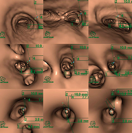 図5　画像処理：仮想気管支内視鏡画像によるナビゲーション画像