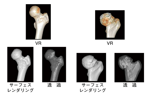 図2　大腿骨頭のVR，サーフェスレンダリング，透過像