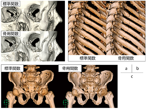 図2　標準関数と骨用関数のVR画像の比較 a：鼻骨骨折症例　b：肋骨骨折症例　c：骨盤骨折症例