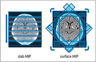 図7　Slab MIPとsurface MIPの違い
