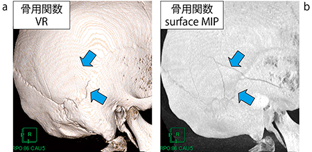 図8　VR画像（a）とsurface MIP画像（b）の骨折線と凹凸の描出能の違い