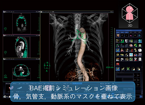 図4　BAE術前シミュレーション画像