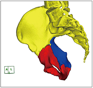 図3　骨片の整復シミュレーション