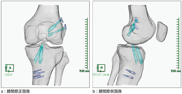 図1　前十字靭帯再建術後3D-CT