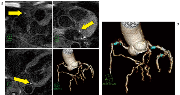 図1　症例1（60歳代，男性） a：冠動脈プラークイメージングによる元画像のHIP（上，左下）と冠動脈MRAのVR画像（右下）。従来の解析は，冠動脈MRAと冠動脈プラークイメージングの元画像を対比させて行っていた。 b：冠動脈MRAのVR画像と冠動脈プラークイメージングのHIPのマルチボリューム画像。HIPを検出した場合，マニュアルで抽出し，VR画像にて画像作成を行っているが，HIPの輝度がVR画像では反映されない。