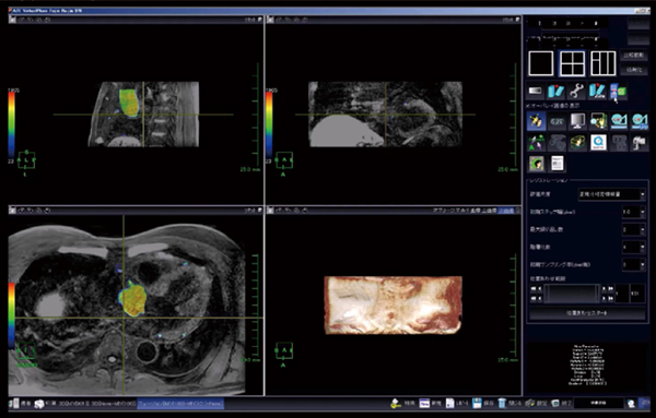 図3　フュージョン機能画面上の冠動脈プラークイメージング フュージョン機能を使用することで，冠動脈プラークイメージング上にカラー化された血管走行情報が反映される。