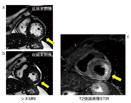 図5　症例2（70歳代，女性） シネMRI（a，b），T2強調画像STIR（c）。シネMRIにおいて後側壁の運動低下を認める。T2強調画像STIRにて同部位に高信号域を認める。