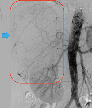 図1　腹部大動脈造影画像（上腸間膜動脈レベルより造影） さまざまな動脈より栄養している。→は副腎腫瘍