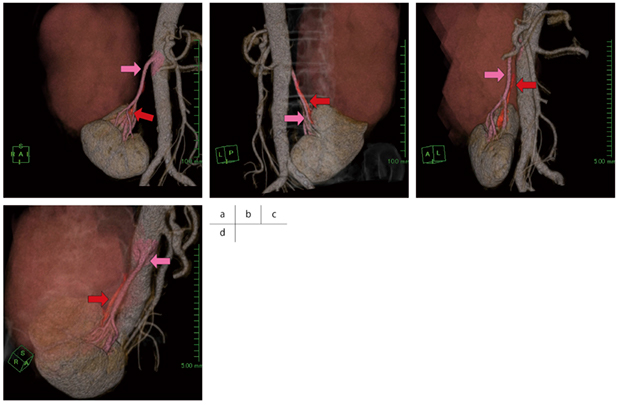 図5　造影CTのVR画像 正面像（a）では，右腎動脈（→）と重なり，腫瘍へ向かって上行する栄養血管（←）の存在がよくわからないが，後面像（b），右上方斜位像（c），右下方斜位像（d）では，右腎動脈に重なる位置に栄養血管が確認できた。