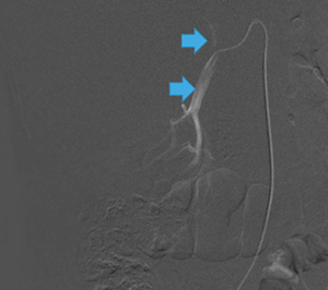 図7　右腎動脈の選択造影画像（反転） VR画像を参考に再度観察したところ，右腎動脈に完全に重なるように上行する血管が認められた（→）。
