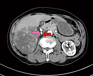 図8　造影CT早期相 右腎動脈（→）　栄養血管（←）