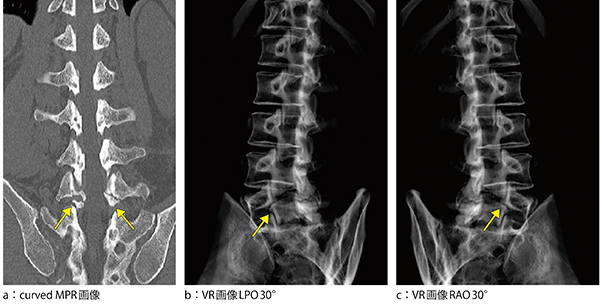 図2　症例2：腰椎分離症（35歳，男性） ↑：上下関節突起間部の欠損