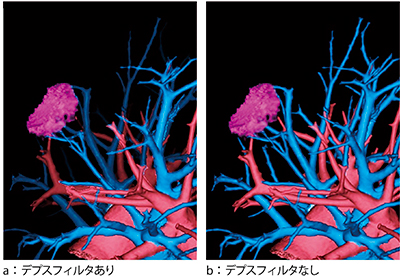 図1　肺がん術前3D-CT画像
