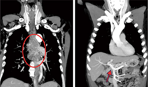 図2　DSIにて撮影した食道がん症例のslab MIP画像 気管支動脈-食道枝，食道動脈などの微細な血管（○）から，時相の異なる門脈（↑）などまで描出されていることがわかる。