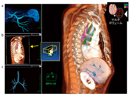図5　マルチボリュームアプリケーション 3シリーズをマルチ展開し，任意のレイヤー（a：門脈，c：気管支）は残しながらボリュームクリッピング（b←） を行うことができる。