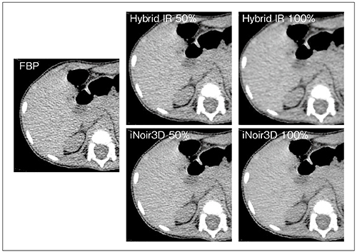 図3　1.25mmのスライス厚におけるFBP，iNoir3DおよびHybrid IRの腹部単純CT画像