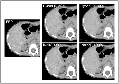 図4　5mmのスライス厚におけるFBP，iNoir2DおよびHybrid IRの腹部単純CT画像