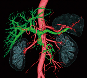 図4　解析例(1)：加算処理で得られた動脈と門脈の融合画像