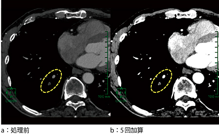 図5　解析例(2)：心臓CT画像における肺塞栓の描出の比較