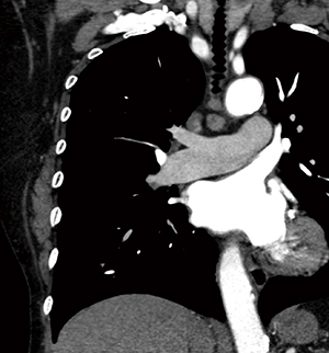 図1　肺静脈優位1相撮影法による取得画像