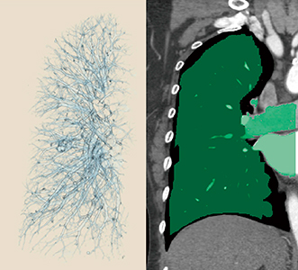 図3　カッターツールとハンマーツールで胸壁と気管支壁を削除した肺野全体像（レイヤー）