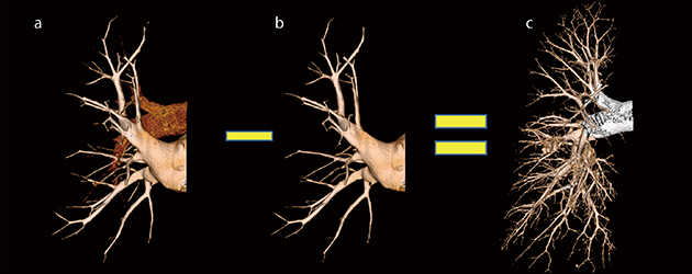 図4　レイヤーサブトラクションメソッド 肺野全体像（a）から，肺動脈抽出のための肺静脈（b）をサブトラクション（引き算）した後，肺動脈（c）を選択抽出する。