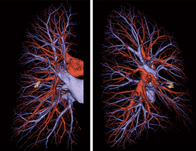 図6　マルチレイヤー表示した肺動静脈分離3D画像