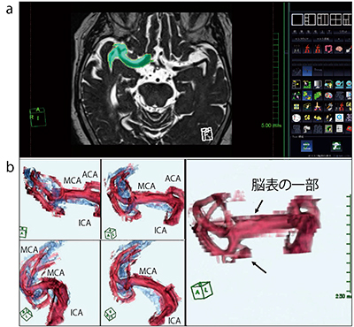 図2　3D-heavy T2WIからの血管抽出方法（従来方法） 3D-heavy T2WIの原画像上で内頸動脈から中大脳動脈をマニュアルで選択し（a），3D構築することでMRAでは確認できない血管分枝が描出できる。しかし，領域選択の際に血管周囲の脳組織を含んでしまうと，血管周囲に脳表の一部が残存し，血管走行が不明瞭になってしまう（b）。髄液腔を青くして血管走行を強調しても，血管分枝がわかりにくい。
