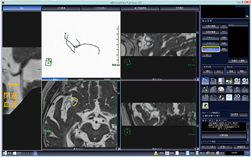 図5　中大脳動脈分枝の画像化（3本目） グラフト3を選択して別の中大脳動脈の血管分枝を追跡し，この血管にも血栓の存在を確認できる。最終的に，3Dの血管分岐のワイヤ像を自由に動かすことで，分岐角度の把握やoperative viewの作成が可能である。