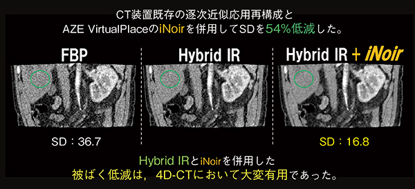 図2　低線量4D-CTにおけるノイズの影響への対策（iNoirとHybrid IR法の併用）