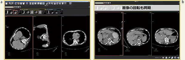 図2　側臥位撮影CTでの経時的比較（Aiの参考症例）