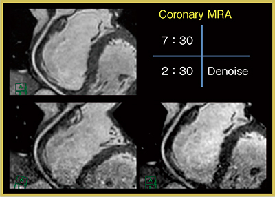 図6　冠動脈MRAにおける撮像時間短縮への応用
