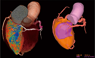 図3　心筋内膜表示と心筋領域分割（右冠動脈狭窄病変）