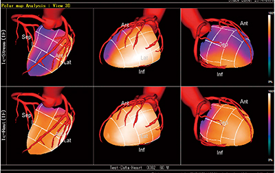 図2　冠動脈CTと心筋SPECTとの重ね合わせ
