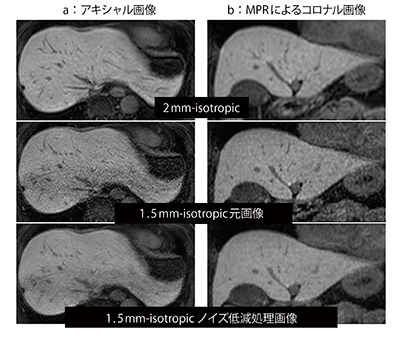 図1　1.5T MRI装置における1.5mm-isotropic画像による例