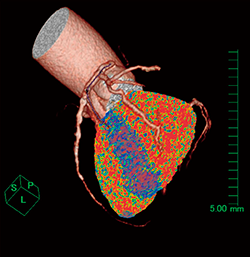 図3　心筋内膜カラーマッピング画像