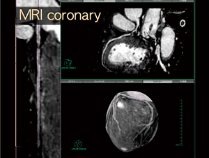 図2　心臓MRIデータから冠動脈を抽出しCPR表示することができる。