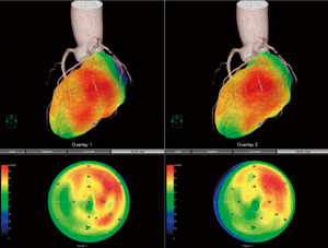 図5　冠動脈CTと心筋SPECTの融合