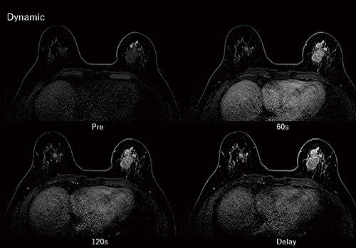 図2　乳房画像（浸潤性乳管癌） 脂肪抑制法Enhanced Fat Freeを用いることにより、両側均一の脂肪制画像が得られている。