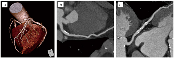 図1　狭心症の心臓CT　a：VR画像　b：LAD　c：LCX 冠動脈プラークや石灰化を高精度に描出可能