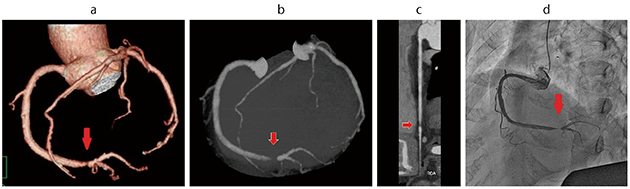 図1　RCA狭窄 豊富な心臓CTアシスト機能により、複雑な操作なく、狭窄部位が高精度に描出できる。 a：TREE画像　b：MIP画像　c：CPR画像　d：血管撮影画像