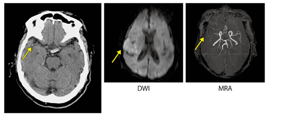 図2　脳梗塞疑い early CT sign（hyperdense MCA sign）が確認でき、CTによる早期の治療方針決定が可能であった。