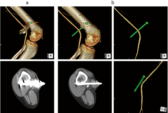 図2　大腿部釘刺し外傷（膝窩動脈へ向かう釘の評価） SEMARによって金属アーチファクトが効果的に低減され、釘と膝窩動脈との接触がないことが確認でき、術式・治療方針が迅速に判断できた。 a：オリジナル　b：SEMAR適用
