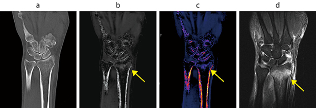 図3　橈骨遠位端骨折 CTで不顕性であったが、BBIで骨折部位が確認できた。3日後のMRIとも良好に一致している。 a：当日CT（骨条件、不顕性）　b：当日CT（BBI白黒）　c：当日CT（BBIカラー）　d：3日後のMRI（T2脂肪抑制）