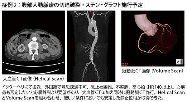 症例2：腹部大動脈瘤の切迫破裂・ステントグラフト施行予定