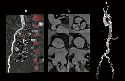 図2　非造影MRIによるTAVI術前評価 血清クレアチニン2.72mg/dL、eGFR 18.7mL/min/1.73m2と腎機能が悪く、造影CTが困難であった症例。アプローチサイトの計測（a）、弁周辺情報の計測（b）、石灰化の評価（c：非造影MRA＋単純CTのフュージョン）で、TAVIに必要な項目が非造影MRIで得られる。